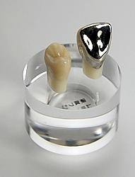 硬質レジンによるクラウン