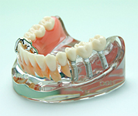 インプラント治療の説明とインプラント費用について