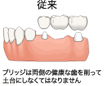 従来の治療はブリッジ