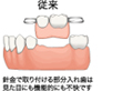 従来の治療は入れ歯
