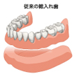 従来の治療は総入れ歯