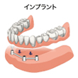 インプラント治療