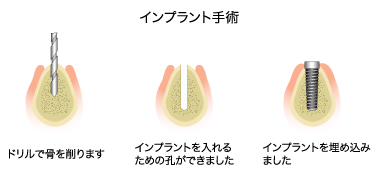 インプラント治療の流れ